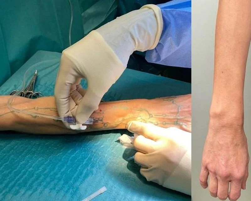 Paplašinātu vēnu ārstēšana kosmētisku sūdzību gadījumā